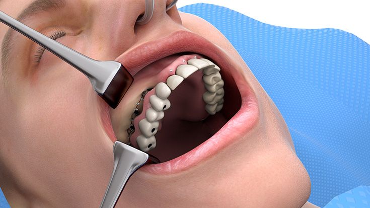 7. Fixierung des provisorischen Zahnersatzes