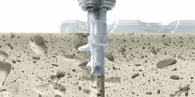 Insertion of SonicPin Rx®