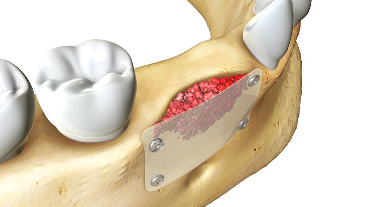 Vertical preprosthetic augmentation