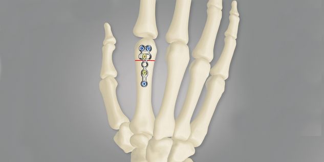 Rotationskorrekturen