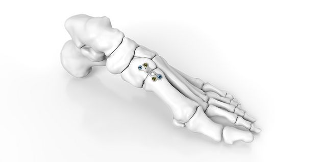 Lapidus Arthrodese