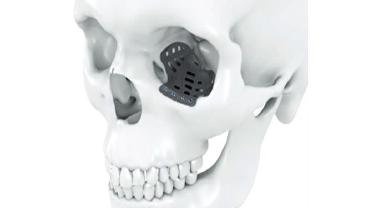 IPS Implants® Orbita