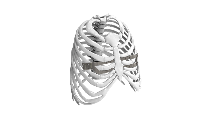 Implants | Reconstruction