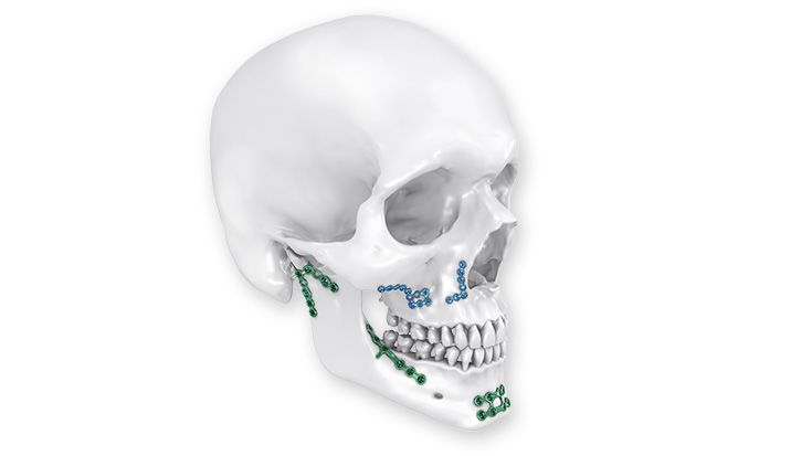 L1® Smart3D | Hohe 3D-Passgenauigkeit