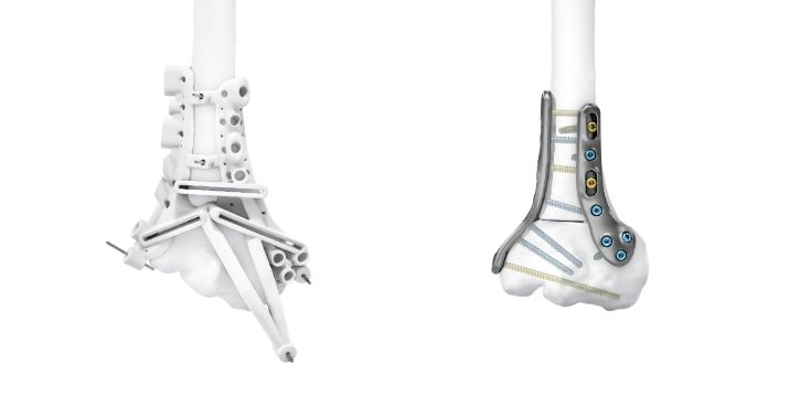 IPS Implants® Radius Reconstruction | Fallbeispiel 1