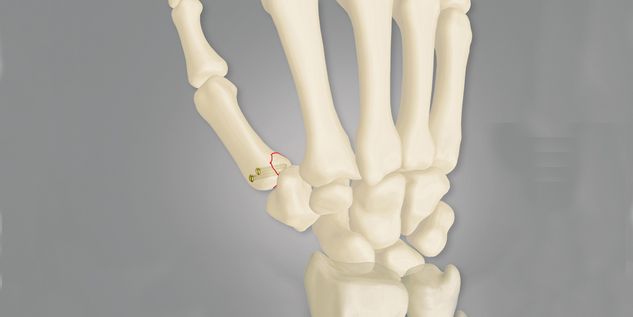 Intra-articular fractures