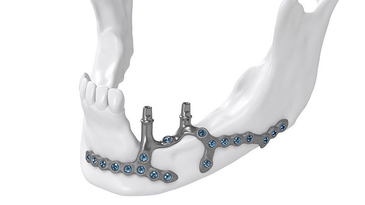 Versorgung des Unterkiefers