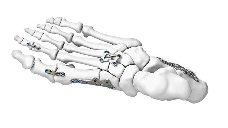 Implantes | Cirugía del pie