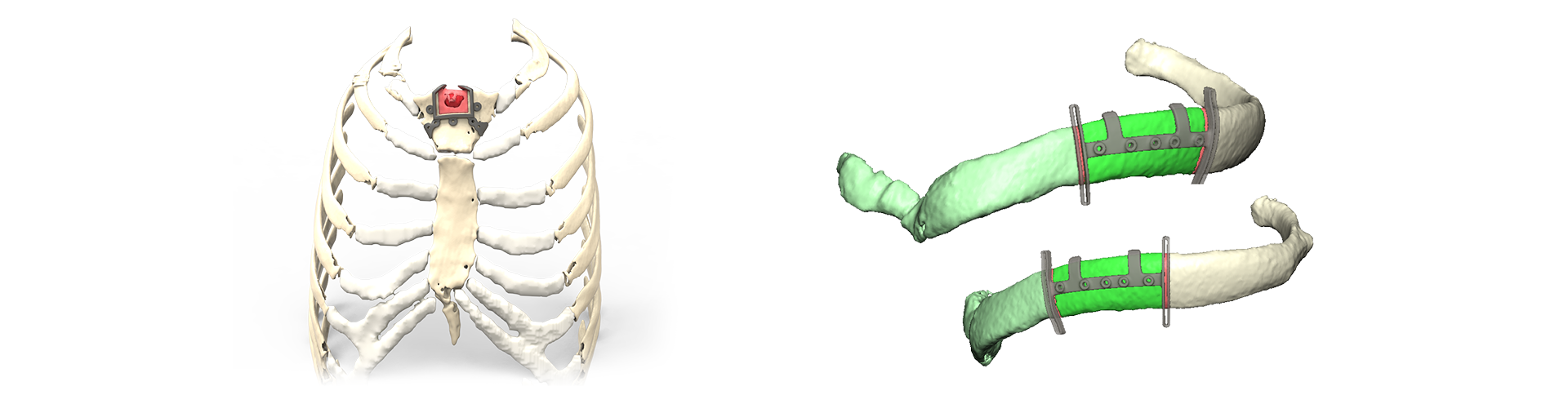 IPS® Thoracic Planning
