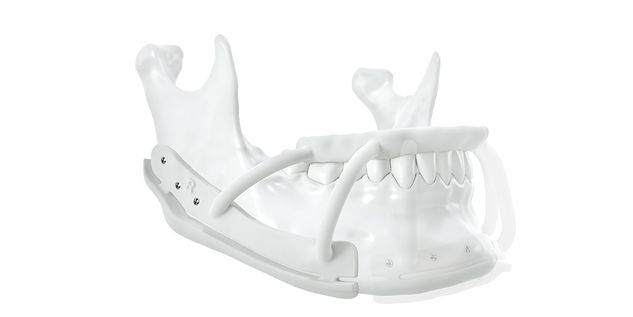 IPS Implants_Transformation_Three-piece design for mandibular marking guides