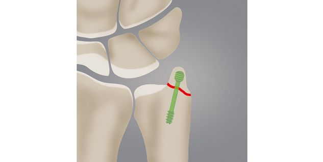 Fraktur des Processus styloideus ulnae