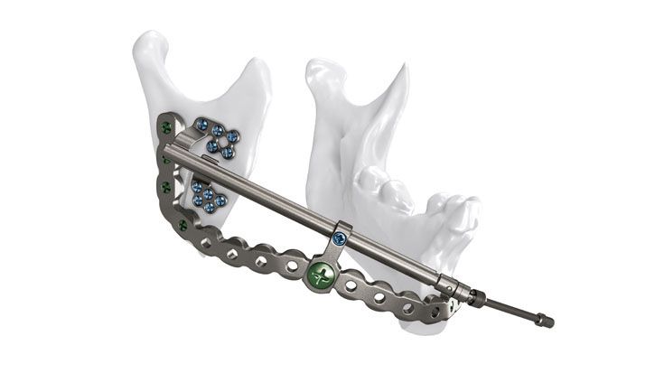 Transport distraction of the mandible