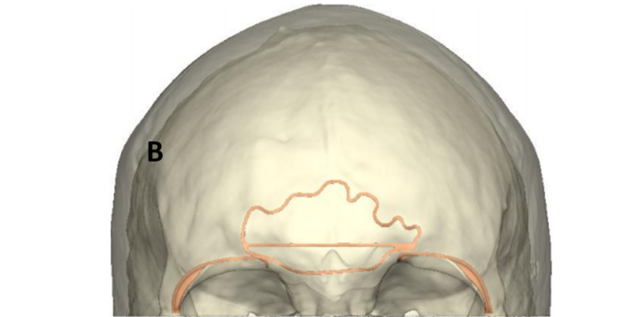 Post-operative model allowing contouring of the resorbable mesh.         