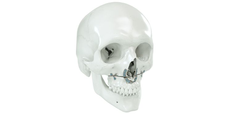 IPS Implants® MI Orthognathics