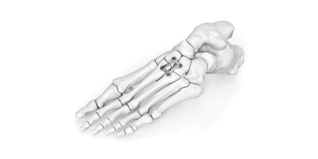 Lisfranc Arthrodese​
