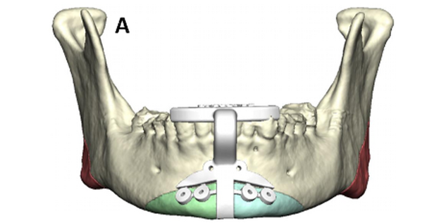 The drill and marking guide with the planned resection and predictive screw holes for the printed plate built into the guide is placed on the mandible.