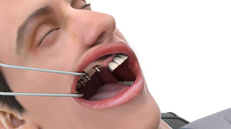 Start der finalen prothetischen Versorgung