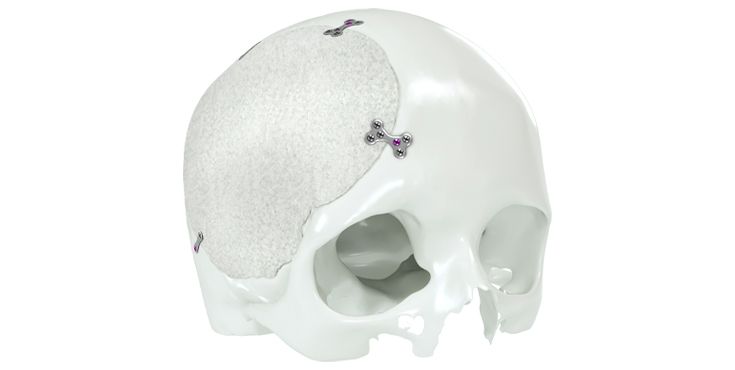 IPS Implants® Cranium