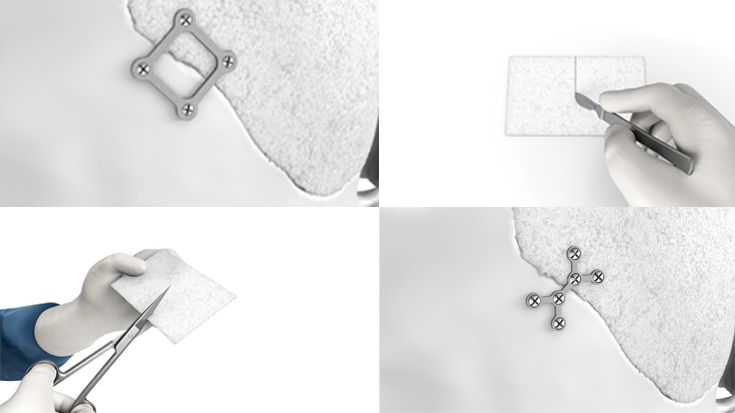 Manipulación y fijación