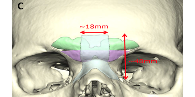 Dimensions of the modified orbital mesh are provided.