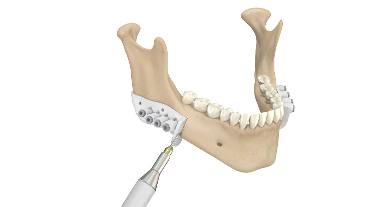 2. Im OP: Resektion des Unterkiefers 
