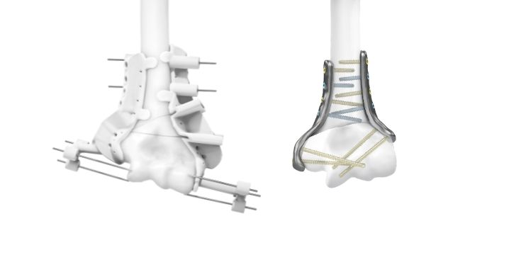 IPS Implants® Radius Reconstruction | Fallbeispiel 4