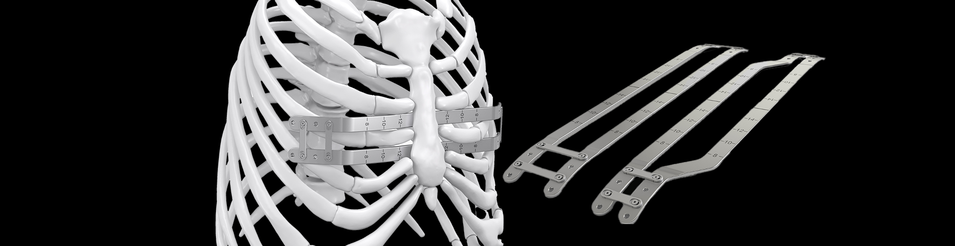 Pure Pectus: Raising the Bar in Pectus Excavatum Repair