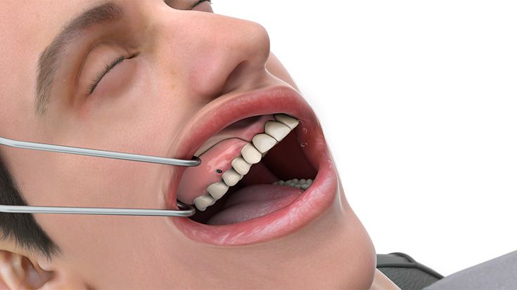 Einsetzen der finalen prothetischen Versorgung