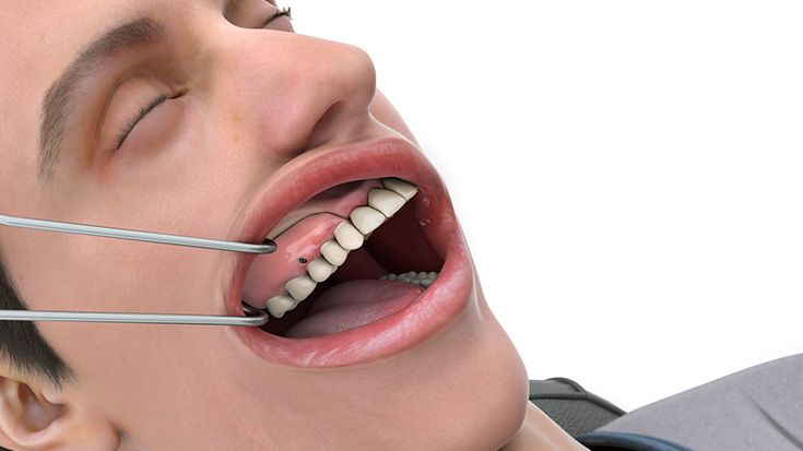 Einsetzen der finalen prothetischen Versorgung