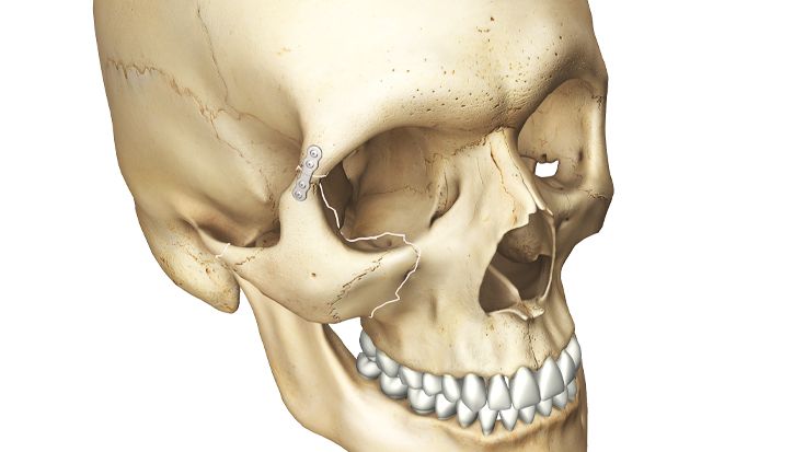 Fracturas del tercio medio facial