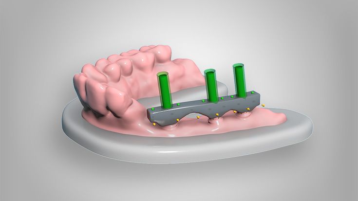 Digitales Designen der Steglösung