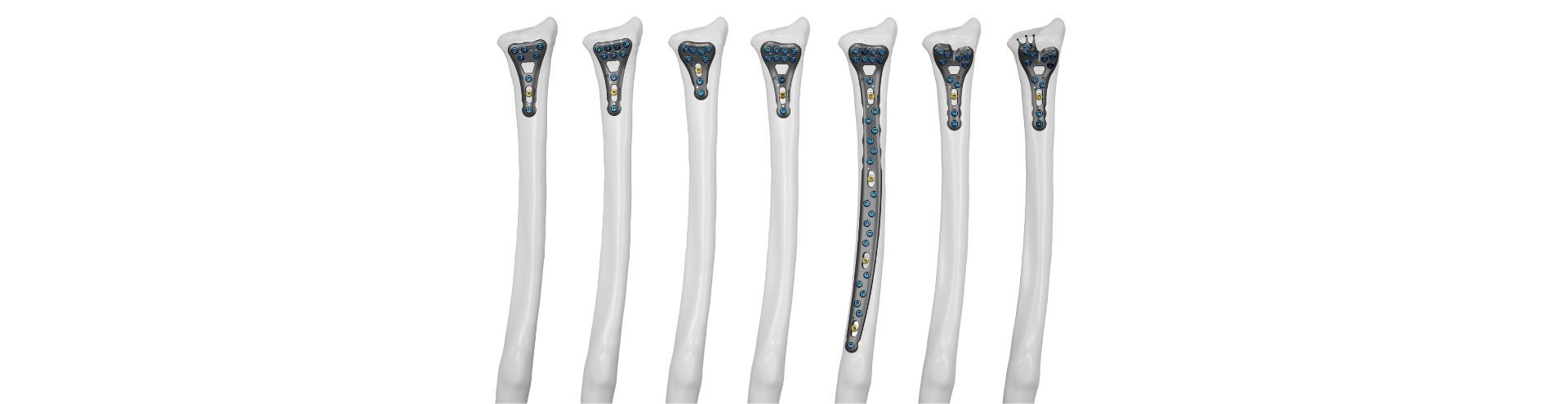 Implantes | Mano  Placas y tornillos