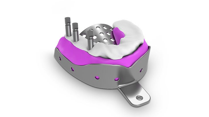 Ausgießen der Abdruckmasse