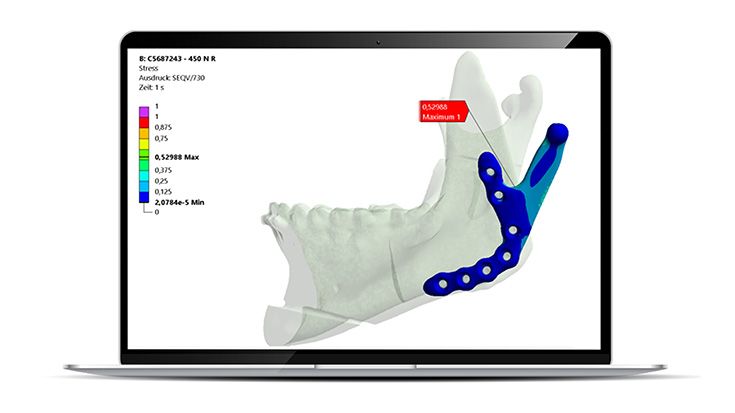 Mechanische Sicherheit durch IPS inSilico® x VIT