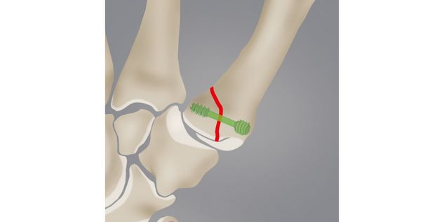 Metacarpal fractures