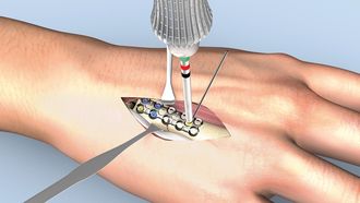 Linos - Querfraktur am Mittelhandknochen
