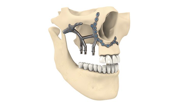 1. Virtuelle Planung