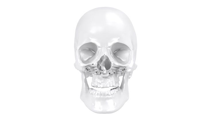 Bilateral distraction of the maxilla