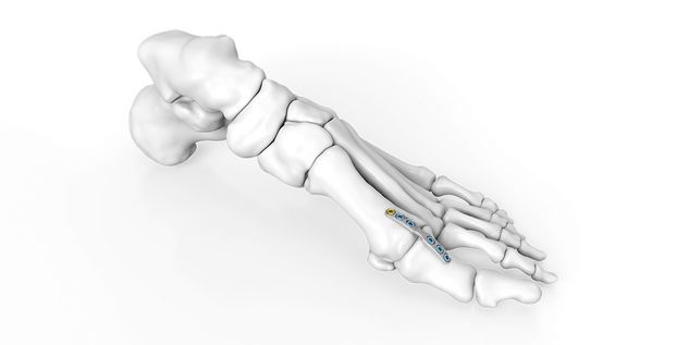 MTP1 Arthrodese​