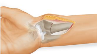 Ixos® Radiusfraktur - Versorgung mit palmarer Watershead-line-Platte 
