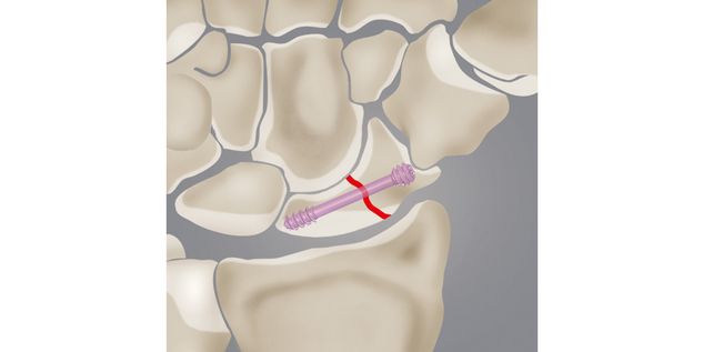 Skaphoidfraktur und Skaphoidpseudarthrose