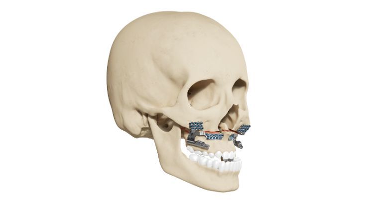 HyperDrive distractores maxilares