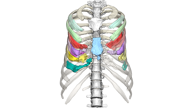 Insertion of the guides and performing the osteotomy