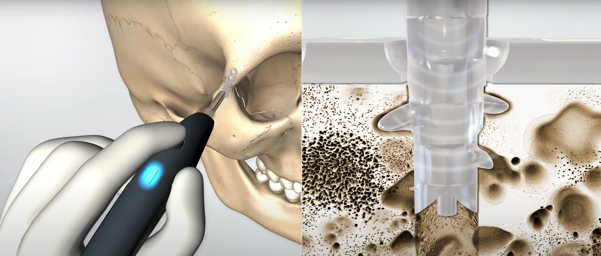 Video functionality of SonicWeld Rx®