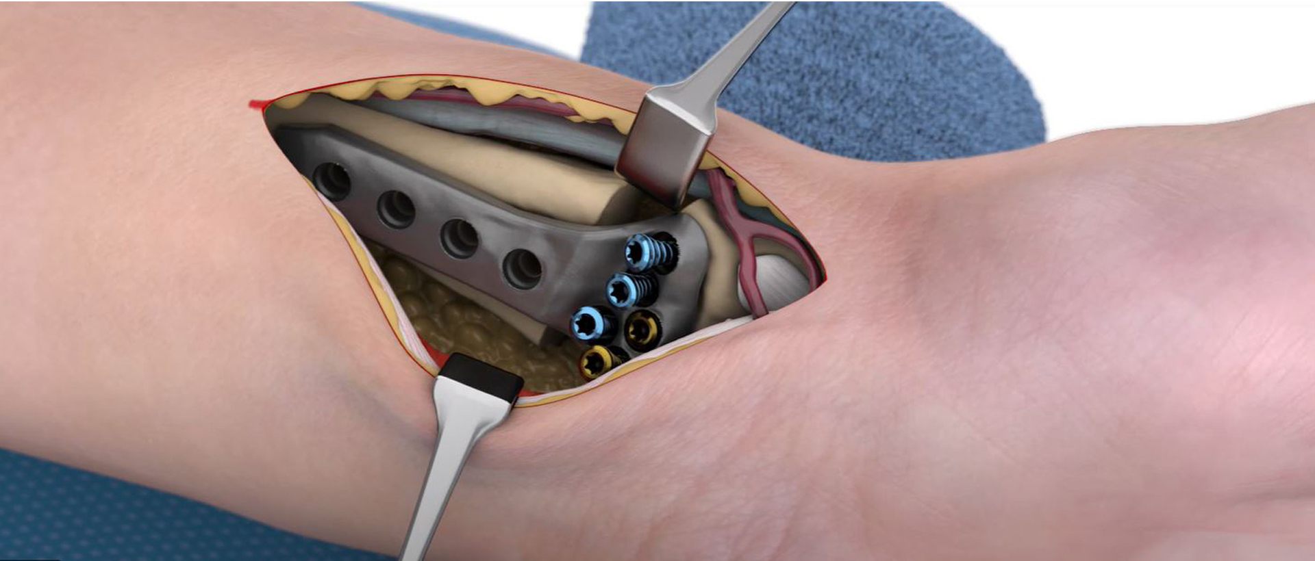 IPS Implants® Radius Reconstruction | patient-specific implants for radius reconstruction