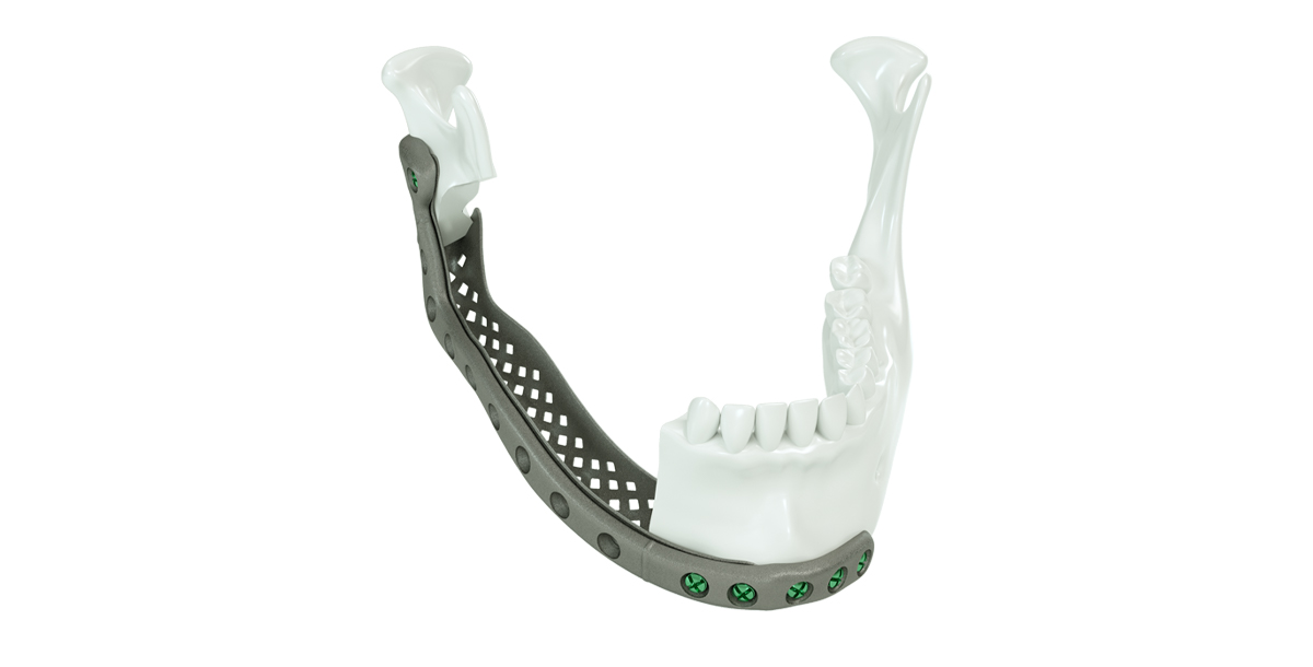 KLS Martin IPS Implants®