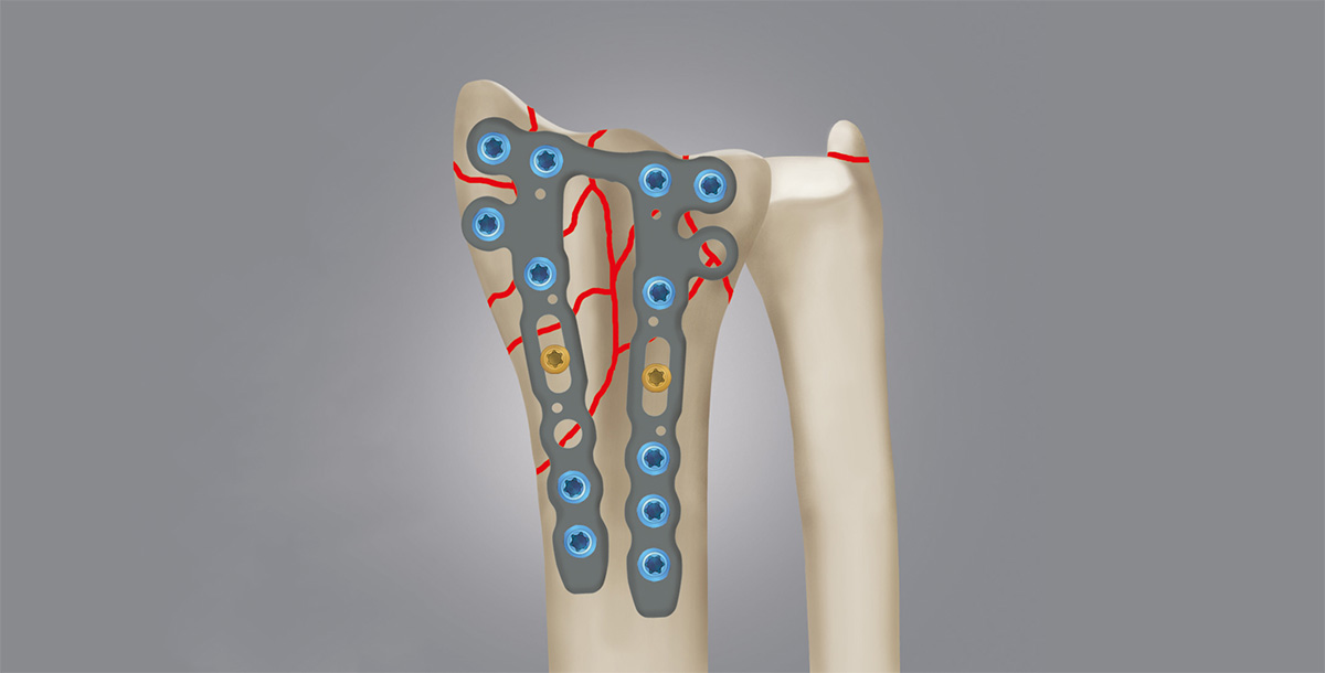 fractura de barton inversa