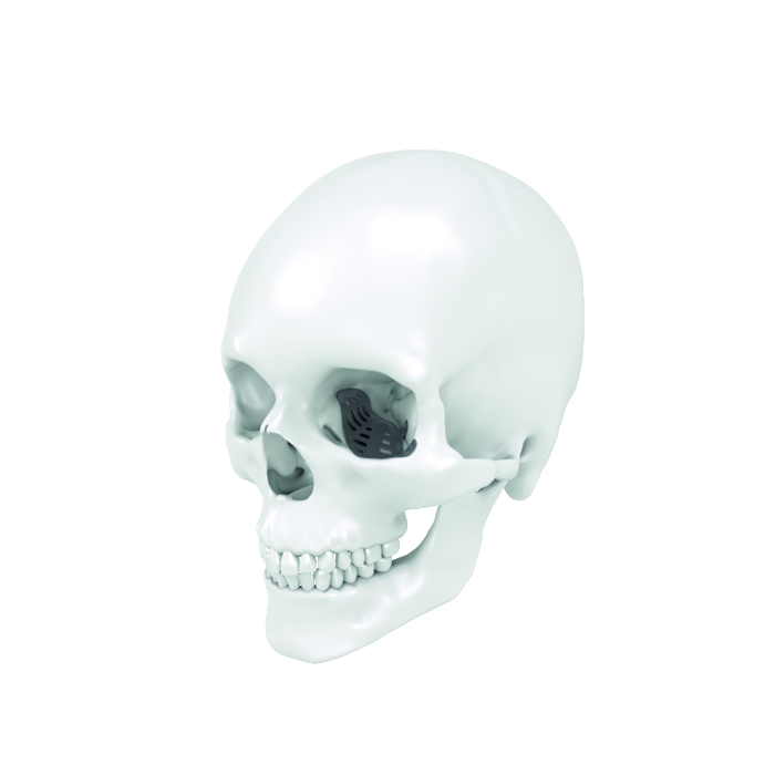 IPS Implants® Midface Orbita