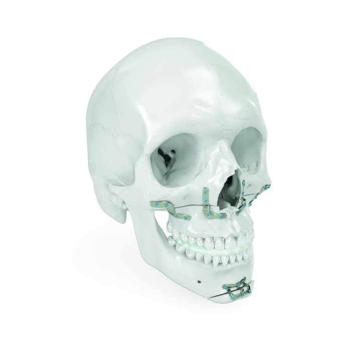 IPS Implants® Orthognathics