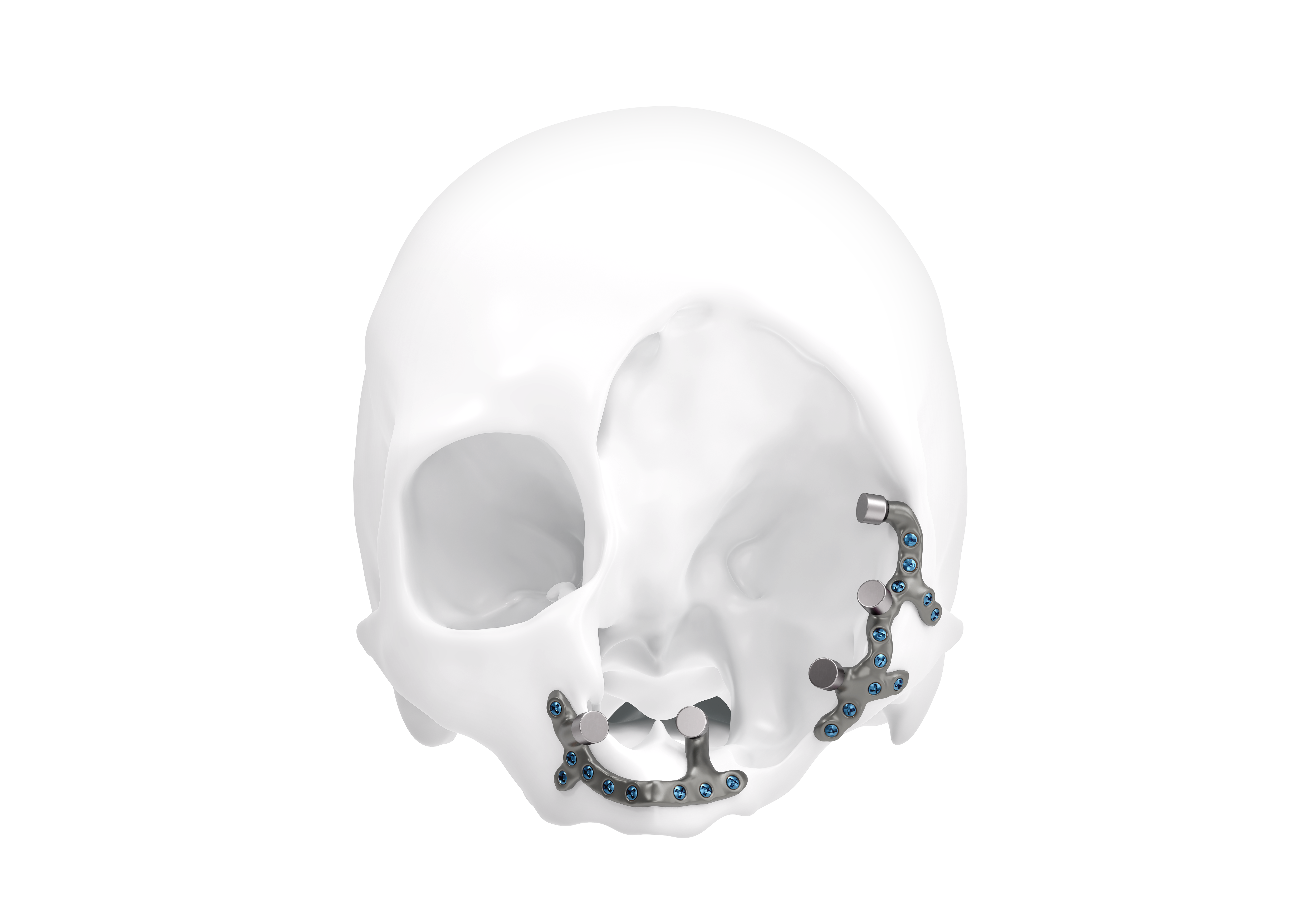IPS Implants® Epithesis Base